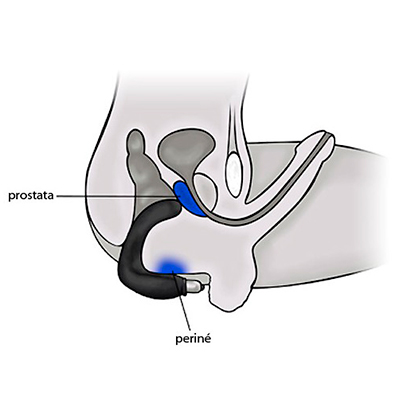 Estimulador de próstata